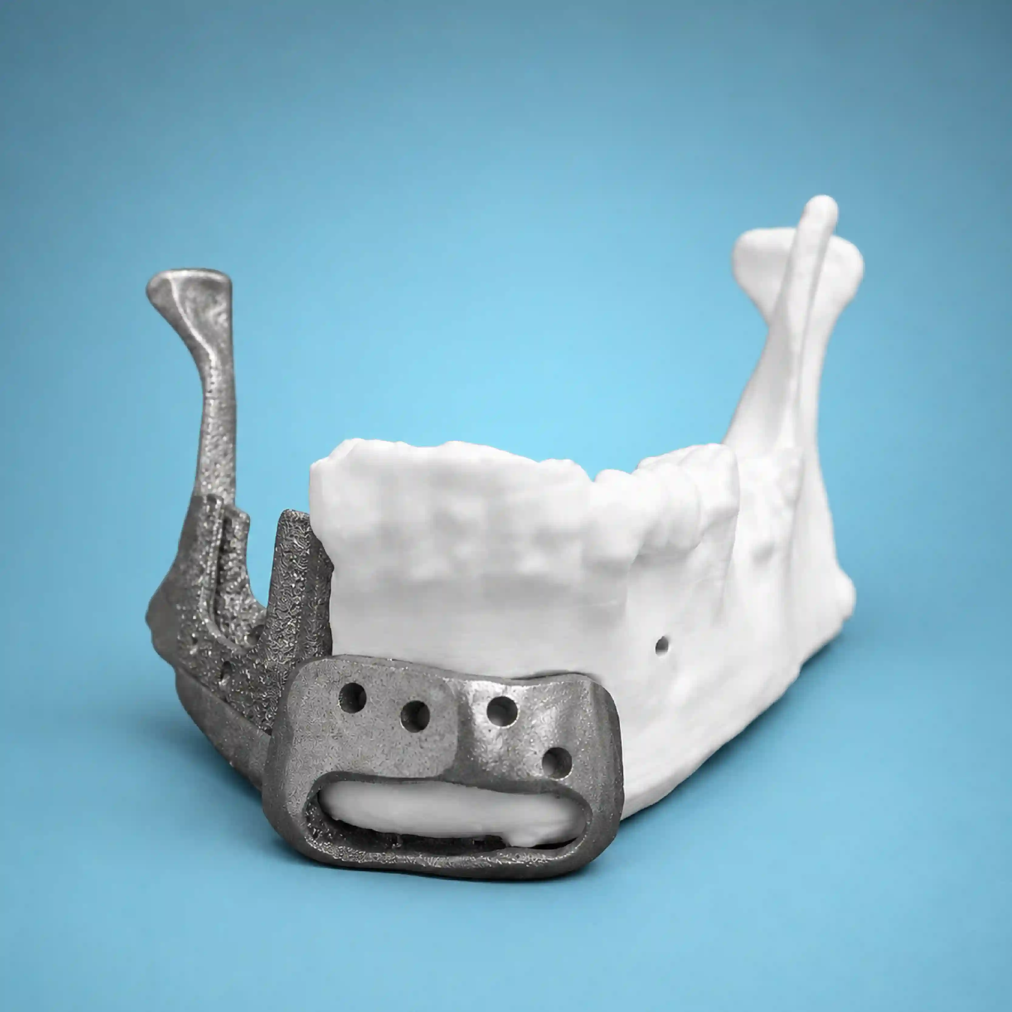 Mandibular implant image