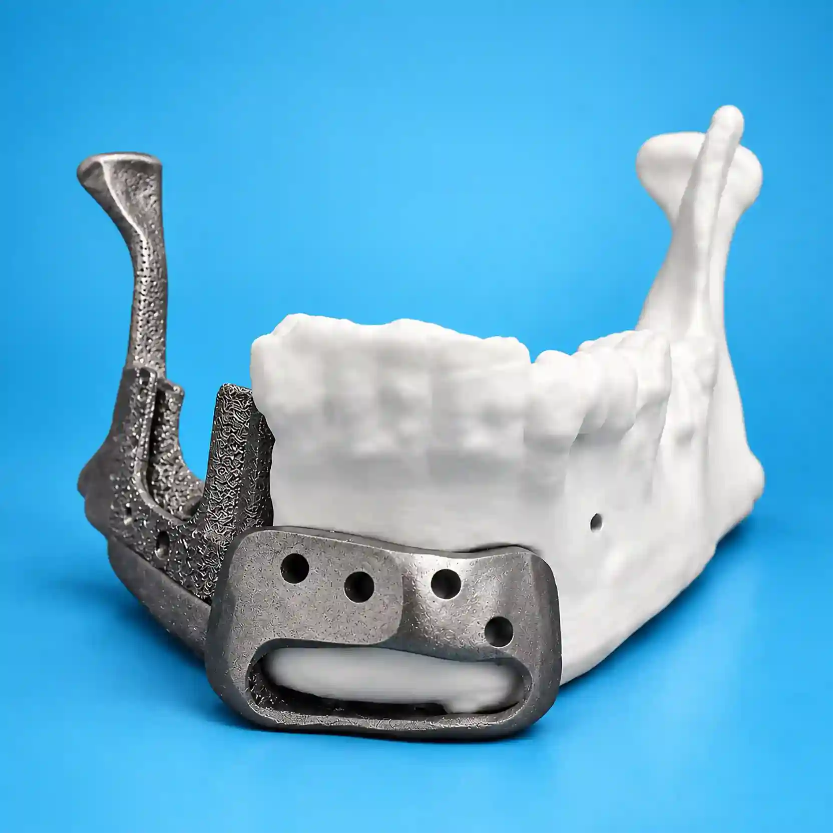 Mandibular implant image
