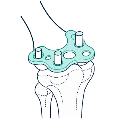 Surgical Guides